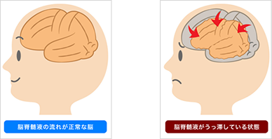 逆に施術後は、脳のむくみと血流が改善し、頭が小さくなっています。