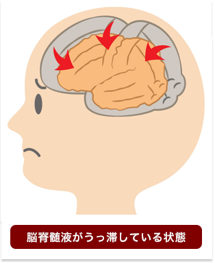 脳脊髄液がうっ滞している状態